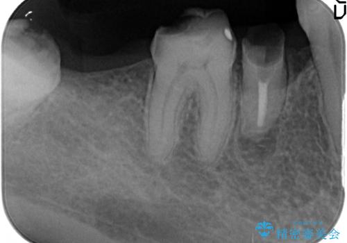インプラント　咬めない奥歯の治療の治療前
