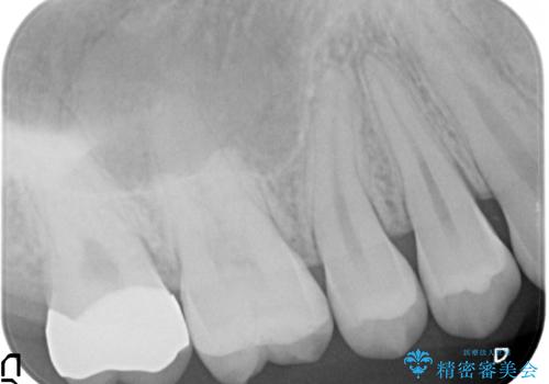奥歯の虫歯　特殊な形をした歯の治療の治療後