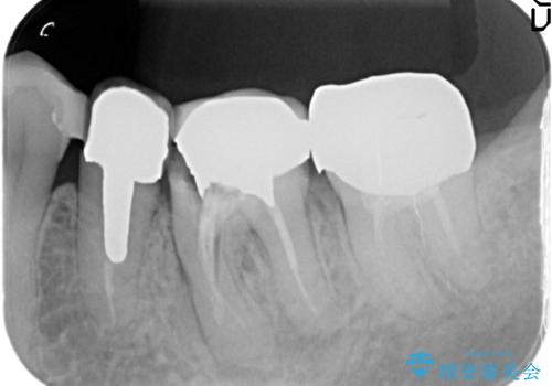 強い咬合力に対抗するメタルボンド補綴の治療前