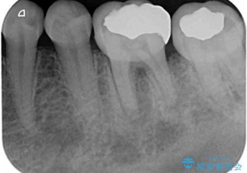 奥歯の虫歯　オールセラミッククラウンによる補綴治療の治療前