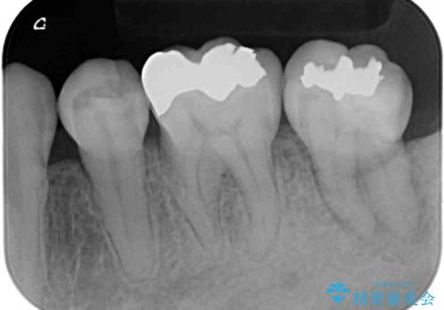 歯周病で抜歯に 奥歯のインプラント治療の治療前