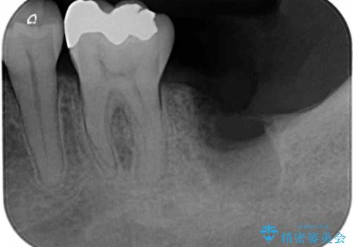 歯周病で抜歯に　奥歯のインプラント治療の治療中