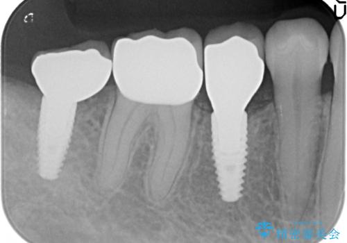 インプラント　咬めない奥歯の治療の治療後