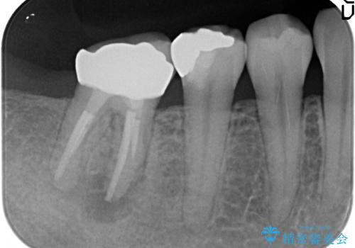 銀歯がしみる PGA(ゴールド)インレーへ 40代女性の治療後