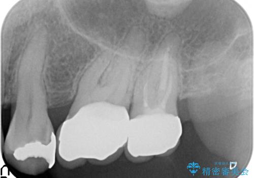 銀歯がしみる PGA(ゴールド)インレーへ 40代女性の治療前