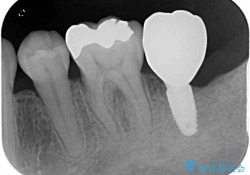 歯周病で抜歯に 奥歯のインプラント治療の治療後