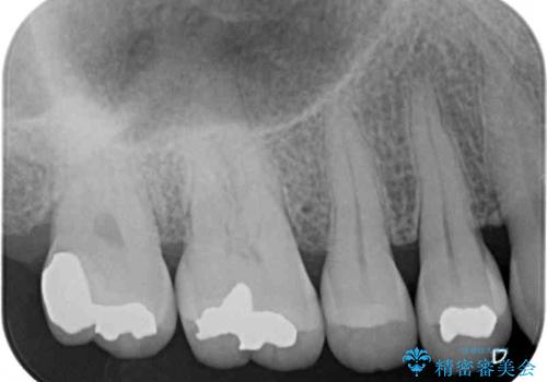 銀歯の中が虫歯になった ゴールドインレーによる修復治療の治療後