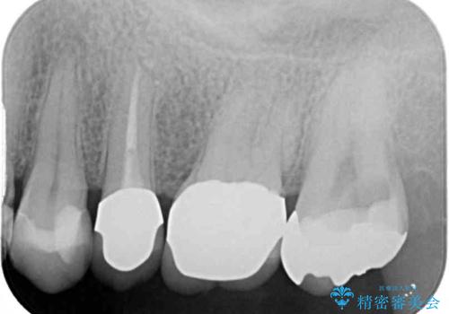 食事で痛む 神経を極力残した虫歯治療の治療前