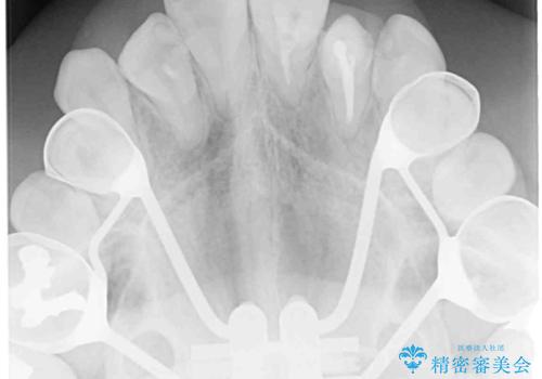 狭い上顎骨を拡大 インビザラインによる非抜歯矯正の治療前