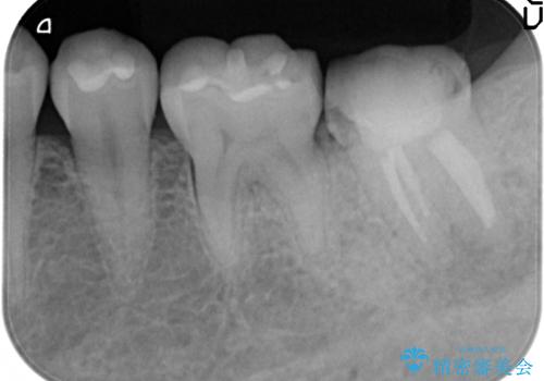 歯冠延長術　他院にてクラウンが入れられないと言われた歯の治療の治療前