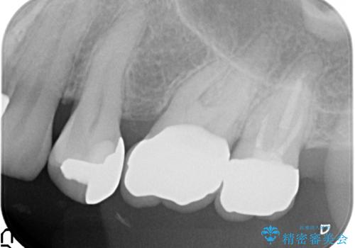 銀歯がしみる PGA(ゴールド)インレーへ 40代女性の治療後