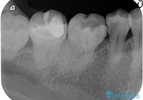 オールセラミッククラウン ズキズキ痛む虫歯の治療の治療前