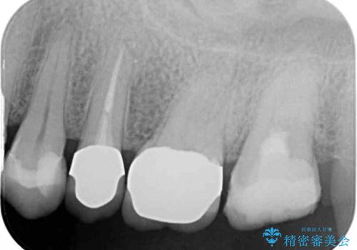 食事で痛む 神経を極力残した虫歯治療の治療中