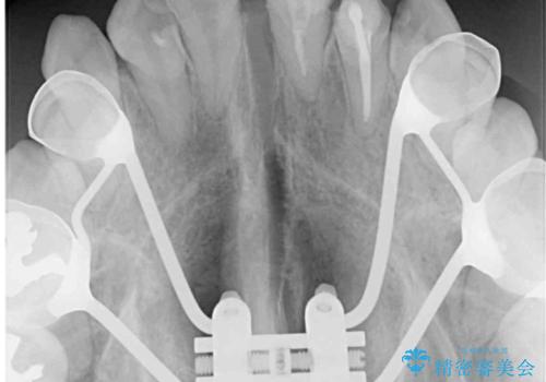 狭い上顎骨を拡大　インビザラインによる非抜歯矯正の治療中