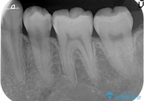 歯と歯の間の虫歯治療　セラミックインレーで治療の治療前