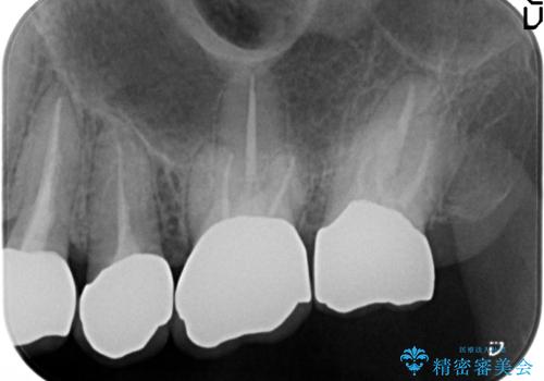 強い咬合力に対抗するメタルボンド補綴の治療後