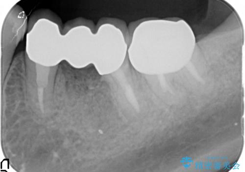 強い咬合力に対抗するメタルボンド補綴の治療後