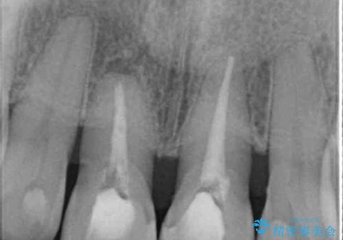 部分矯正とセラミック 前歯の審美治療の治療前