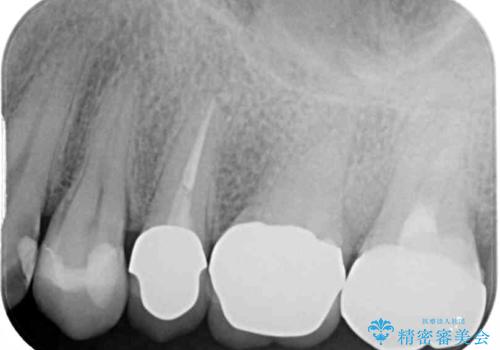 食事で痛む 神経を極力残した虫歯治療の治療後