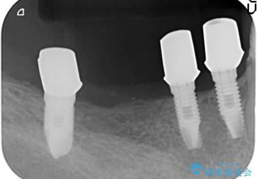 奥歯のインプラント治療の治療中