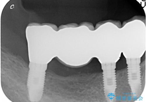 奥歯のインプラント治療の治療後