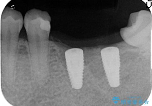 インプラント　失ってしまった奥歯の再建の治療後