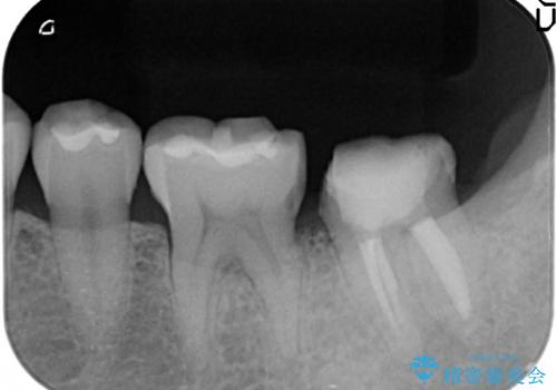 歯冠延長術 他院にてクラウンが入れられないと言われた歯の治療の治療後