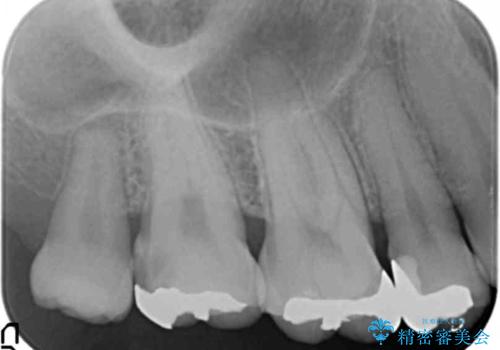 食べ物が詰まる 親知らずが原因の虫歯再発の治療前