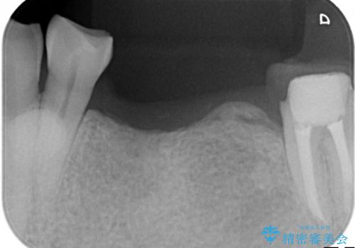インプラント　失った奥歯の欠損補綴の治療前
