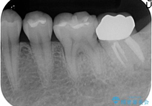 歯冠延長術 他院にてクラウンが入れられないと言われた歯の治療の治療後