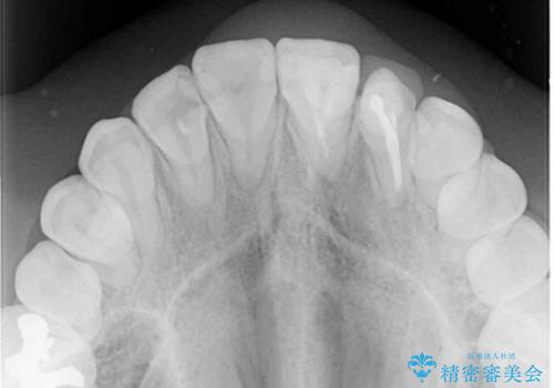 狭い上顎骨を拡大 インビザラインによる非抜歯矯正の治療後