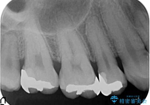 食べ物が詰まる 親知らずが原因の虫歯再発の治療後