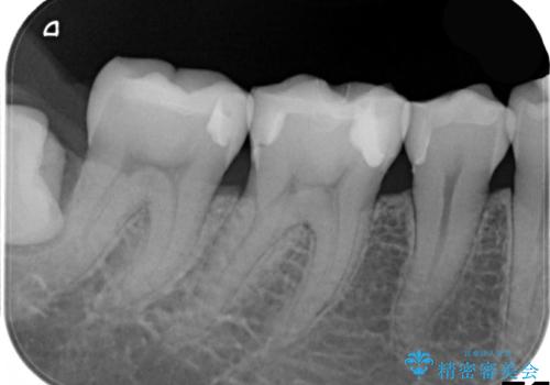歯と歯の間に食べ物がつまる、金属を白くしたい、セラミックインレーにて修復の治療後