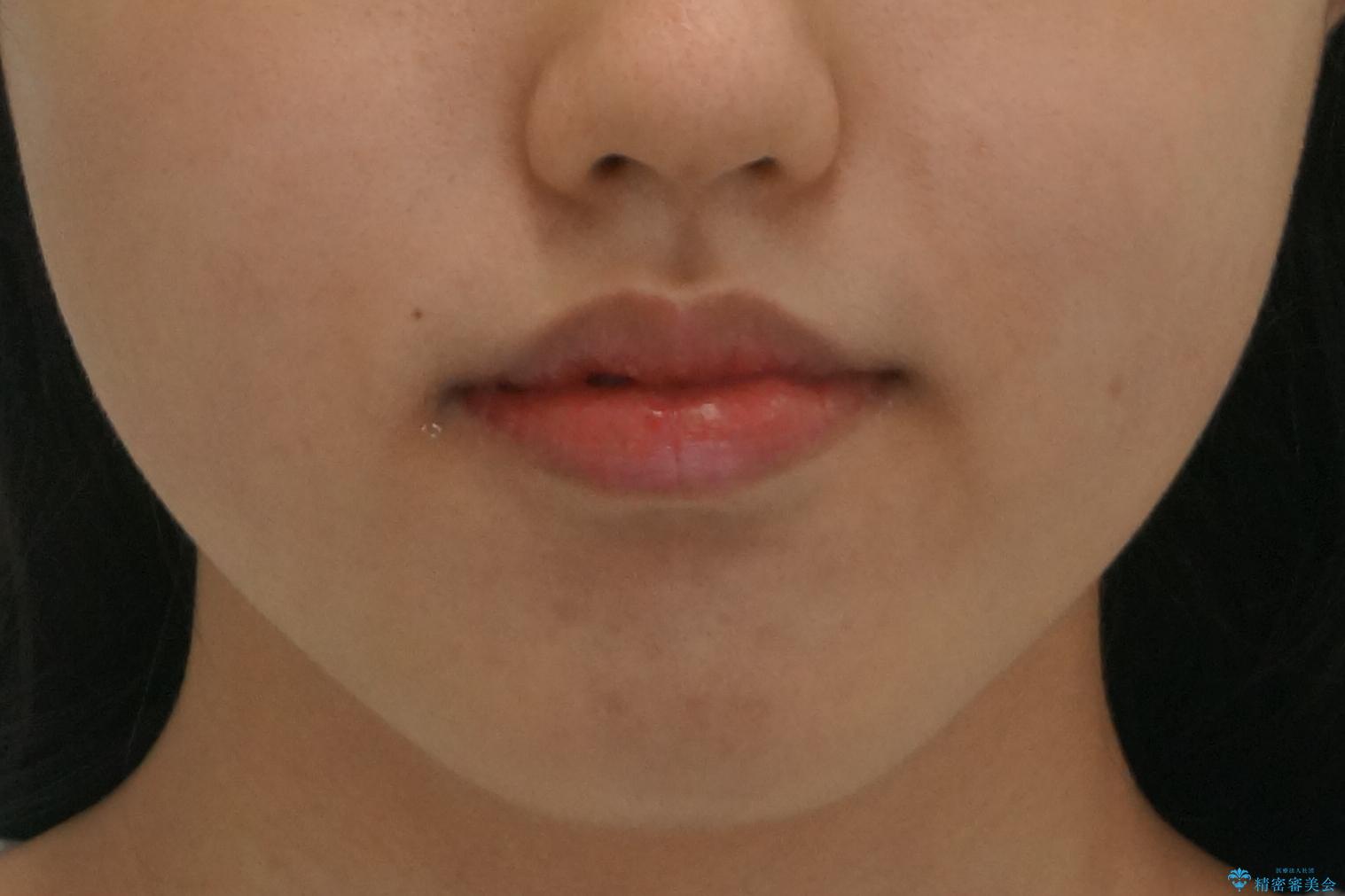 中学生のマウスピース矯正 歯を抜かずにキレイにの治療後(顔貌)