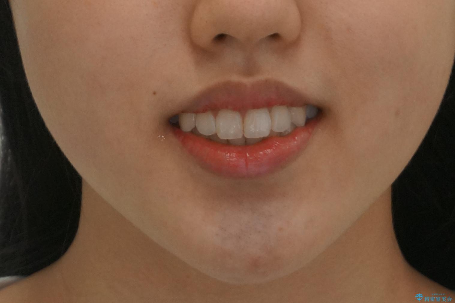 中学生のマウスピース矯正　歯を抜かずにキレイにの治療後（顔貌）