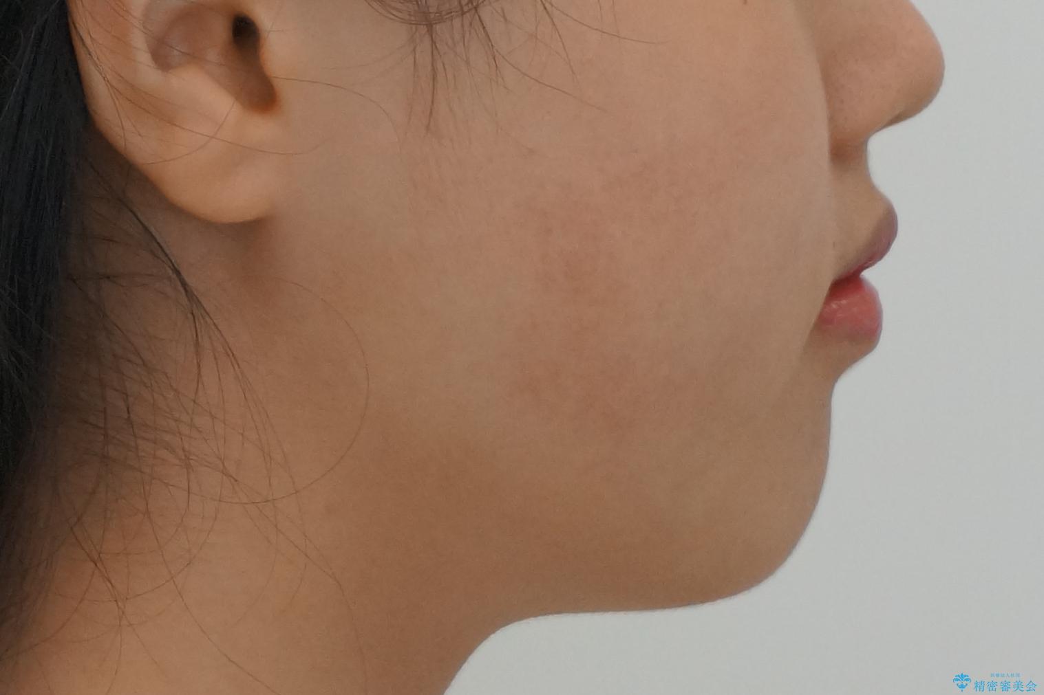 中学生のマウスピース矯正 歯を抜かずにキレイにの治療後(顔貌)