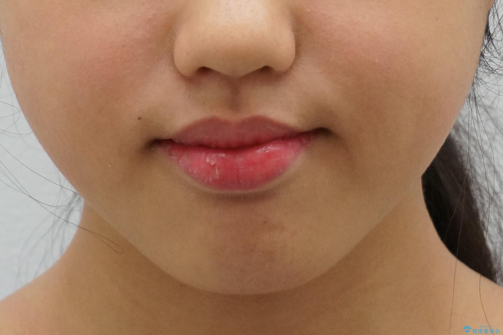 中学生のマウスピース矯正 歯を抜かずにキレイにの治療前(顔貌)