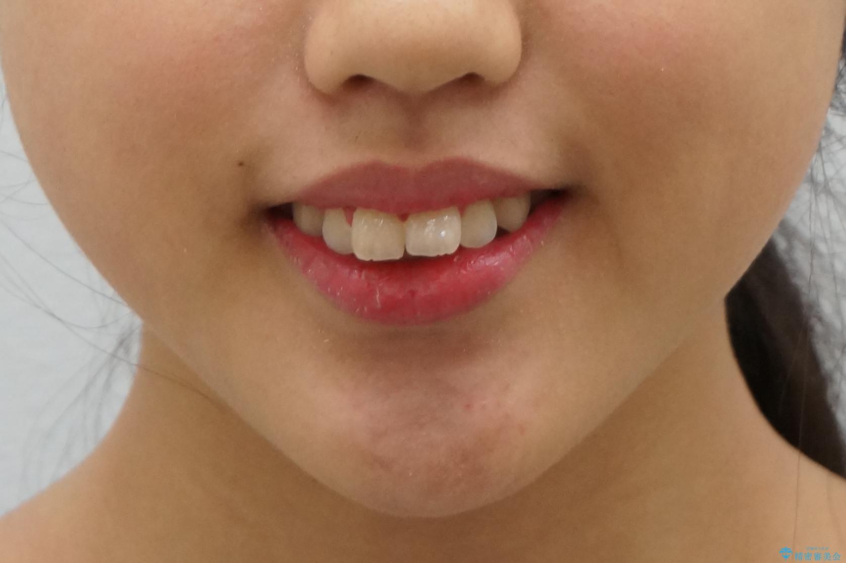 中学生のマウスピース矯正 歯を抜かずにキレイにの治療前(顔貌)