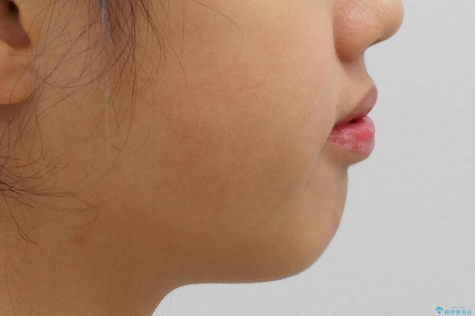 中学生のマウスピース矯正 歯を抜かずにキレイにの治療前(顔貌)