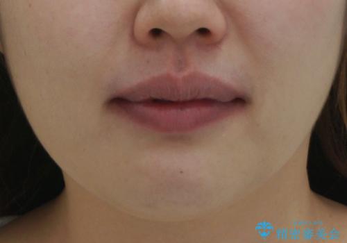 えっ シワが矯正で消えちゃう・・・? ボトックスから卒業しようの症例 治療後