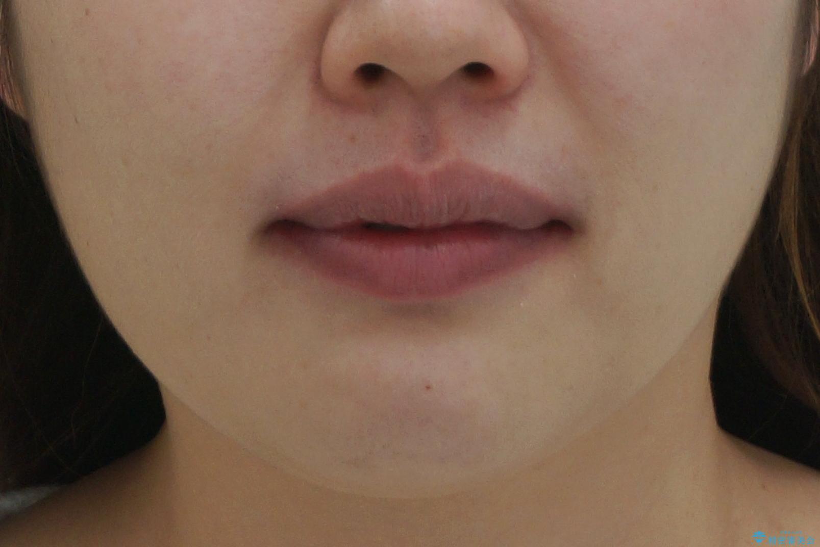 えっ シワが矯正で消えちゃう・・・? ボトックスから卒業しようの治療後(顔貌)