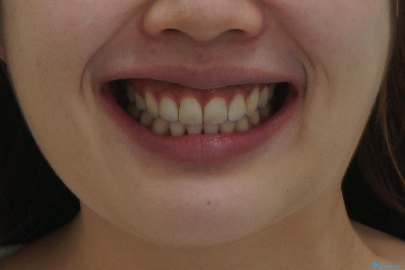 えっ シワが矯正で消えちゃう・・・? ボトックスから卒業しようの治療後(顔貌)