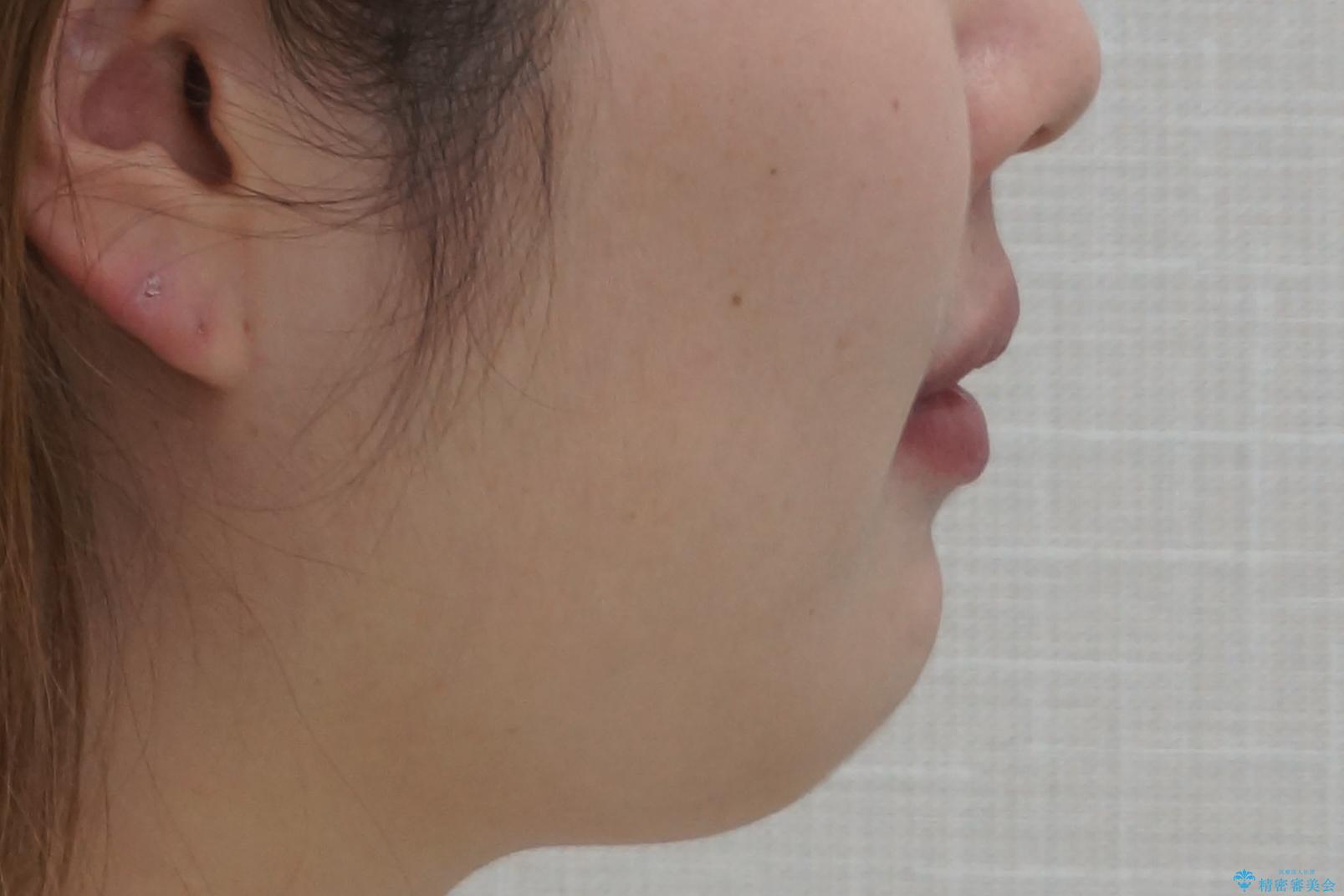 えっ シワが矯正で消えちゃう・・・? ボトックスから卒業しようの治療後(顔貌)