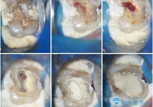 食事で痛む 神経を極力残した虫歯治療の治療中