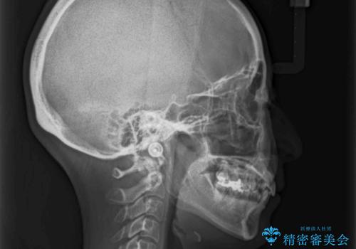 八重歯のインビザライン矯正治療の治療前