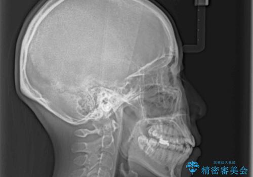 上下の八重歯を治したい インビザラインと補助装置を用いた抜歯治療の治療前