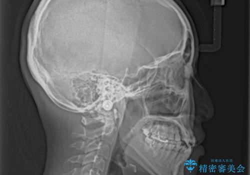 前歯のクロスバイトを治したい インビザラインによる矯正治療の治療前