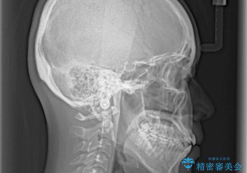 オープンバイトでかみにくい インビザラインによる矯正治療の治療前
