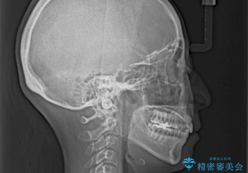 八重歯のインビザライン矯正治療の治療後