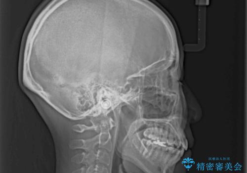 上下の八重歯を治したい インビザラインと補助装置を用いた抜歯治療の治療後